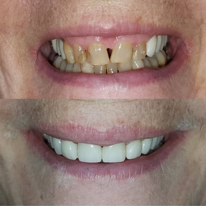 Before and after dental implant results at Kings Dental
