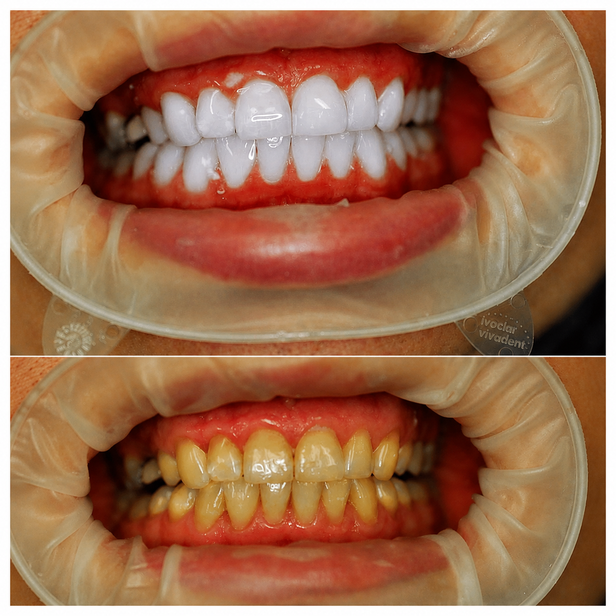 Before and after porcelain veneer results at Kings Dental