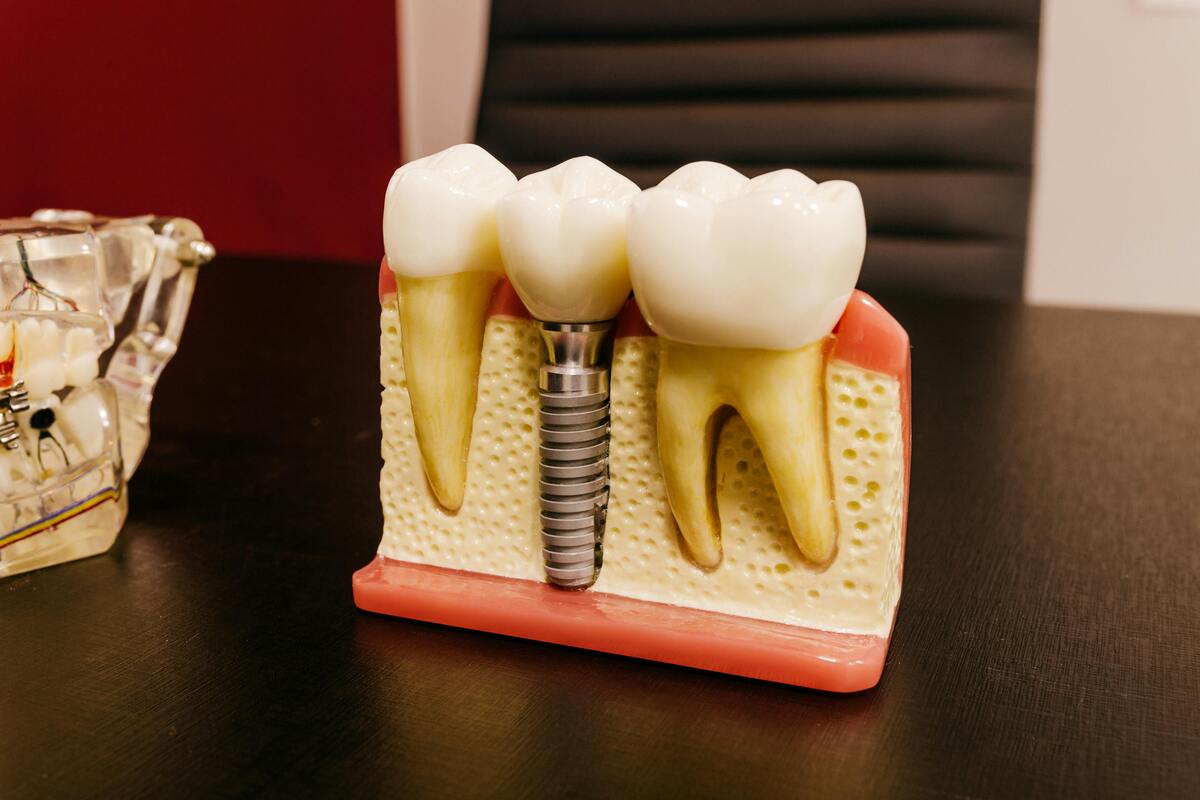 A tabletop display model of a dental implant